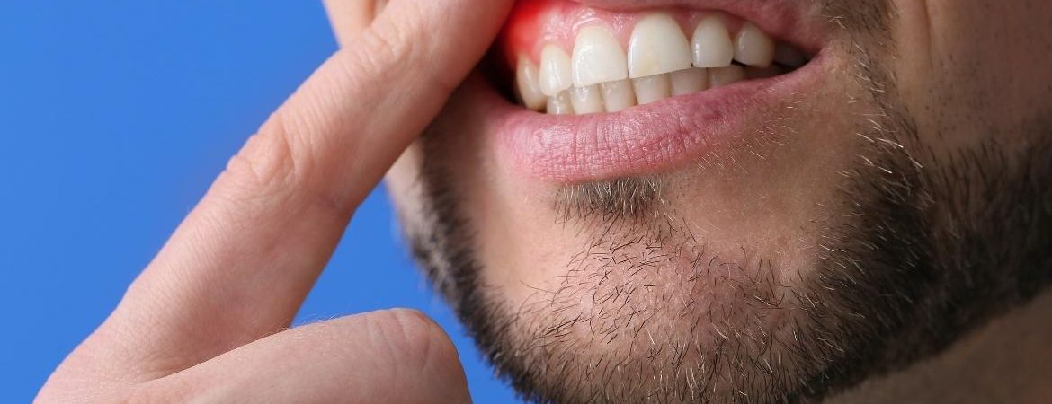 Diş Eti Çekilmesi Tedavisi